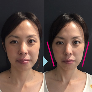 大阪で小顔矯正なら Re Face 専門家が絶賛する本物の技術力