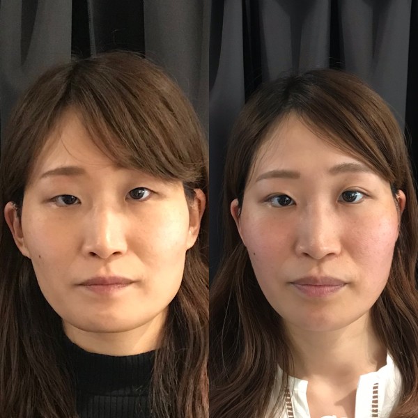 大阪で小顔矯正なら「Re:face」専門家が絶賛する本物の技術力